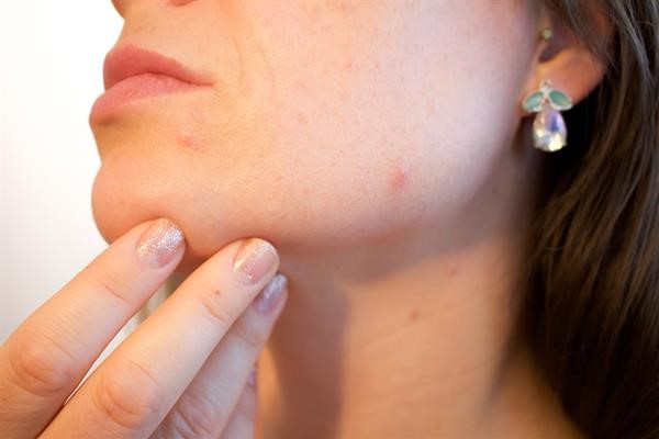 Acne pain in the face