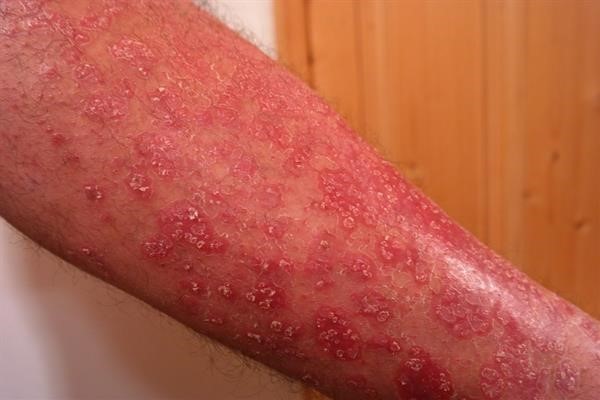 Dealing with Dermatitis