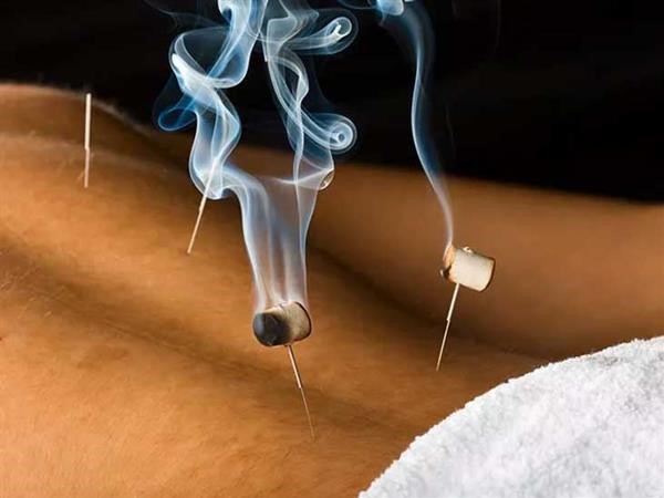 Moxibustion & Acupuncture in Miami Beach